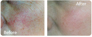threat vein treatment before and after photos