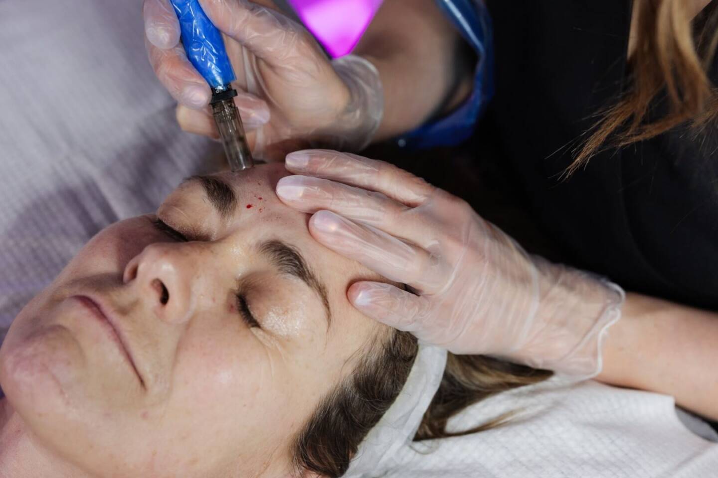rejuvapen microneedling facial